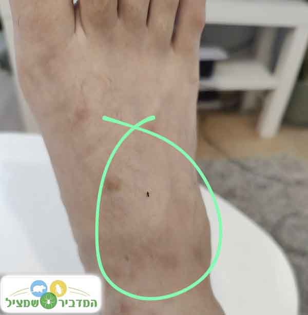 פרעוש על הרגל